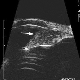 Iridociliary melanoma