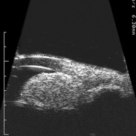 Iris Melanocytoma