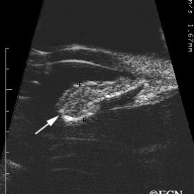 Iris Melanoma