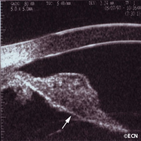 Iris Melanoma