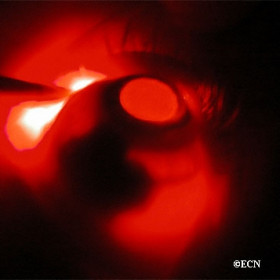 Irregularly shaped uveal melanoma