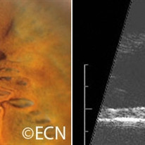 Iris Pigment Epithelial Cyst