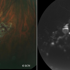 Cavernous Hemangioma