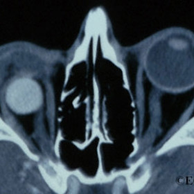 Enucleation Implant