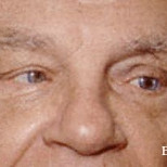 Enucleation with implant I