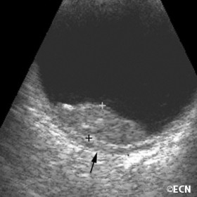 Metastatic choroidal tumor