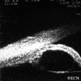 Neuroepithelial iris cyst