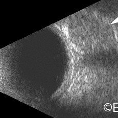 Orbital Hemangioma
