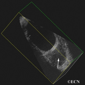 Orbital Lymphoma