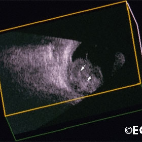 Retinoblastoma