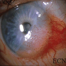 Squamous carcinoma of the conjunctiva with corneal extension