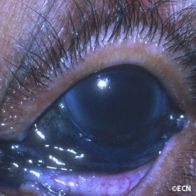 Conjunctival Argyrosis