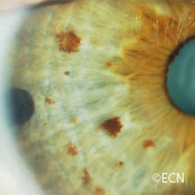 IPE cyst