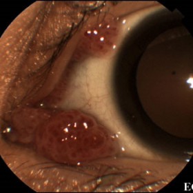 Squamous papilloma of the conjunctiva.