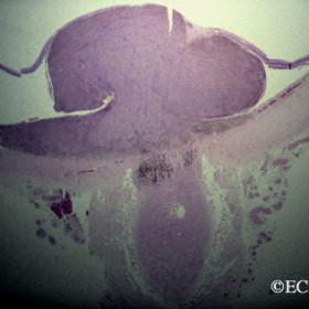 Choroidal melanoma of the optic nerve