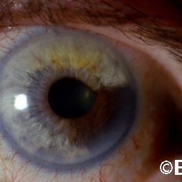 Iridociliary Melanoma