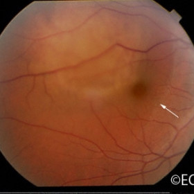 Choroidal metastasis