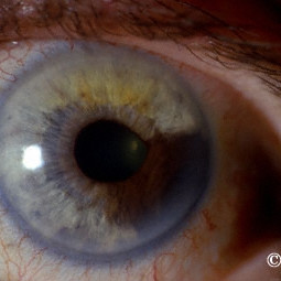 Iridociliary melanoma