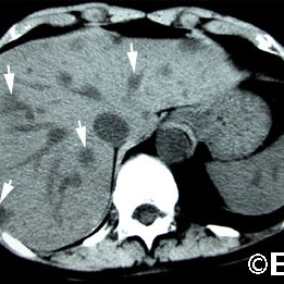 Liver metastasis