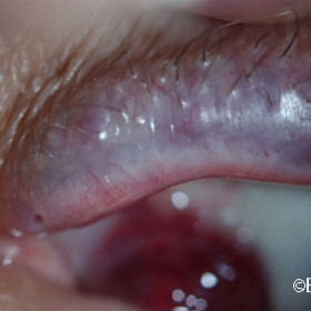 Lympangioma