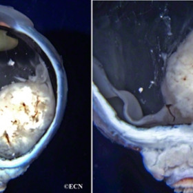 Retinoblastoma