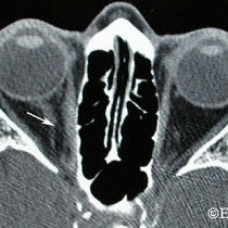 Orbital lymphoma
