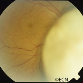 Choroidal melanoma
