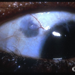 Scleromalacia...