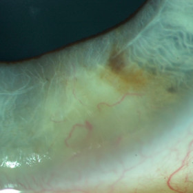 Iris Melanoma