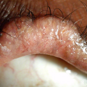 Sebaceous carcinoma (diffuse)