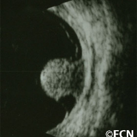 Choroidal melanoma