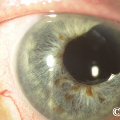 Iris Melanoma