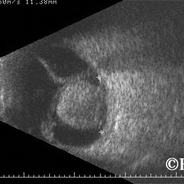 Choroidal melanoma