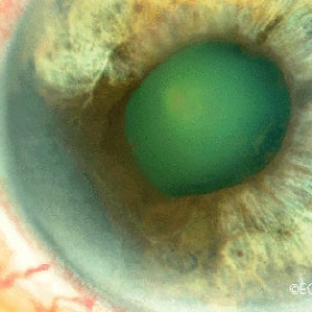 Iris Melanoma