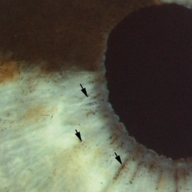 Iris Melanoma