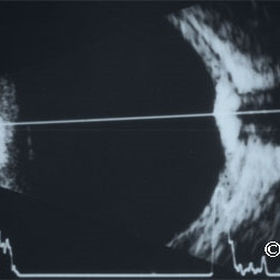 Choroidal osteoma