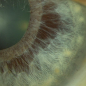 Iris Stromal Atrophy