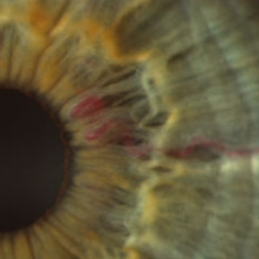 Iris Varix