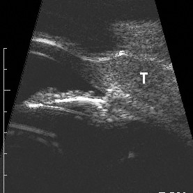 Epibulbar squamous carcinoma
