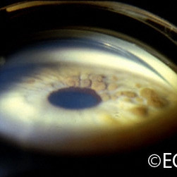 Multiple iris nevi