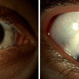 Ocular Melanosis