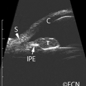Iris Melanoma