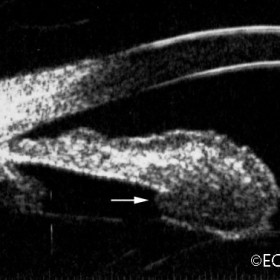 Iris Melanoma