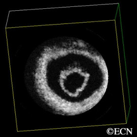 Retinal Detachment