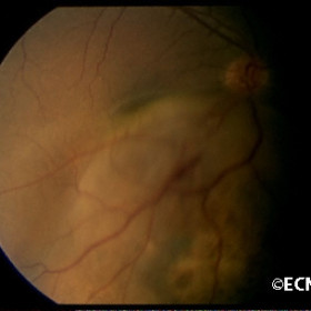 Choroidal metastasis
