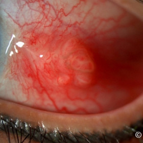 Suture granuloma
