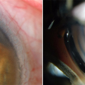 Iris Cyst
