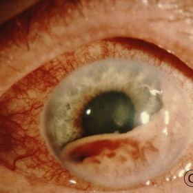 Iris Metasis Lung