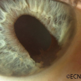 Iris ectropion uveae