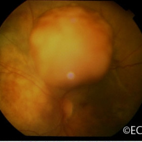 Choroidal Melanoma